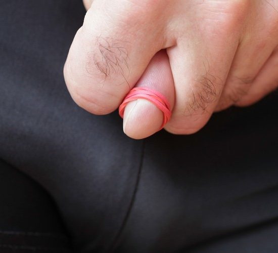 Phimosis tight foreskin in adults